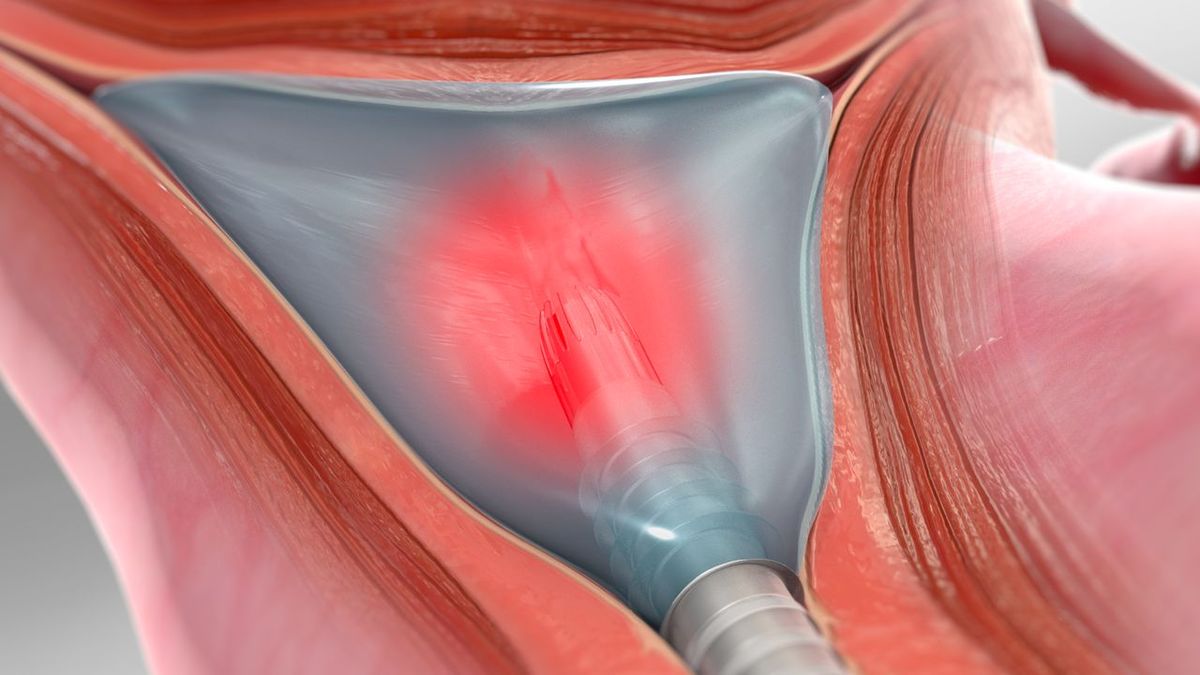 Surgical adhesions