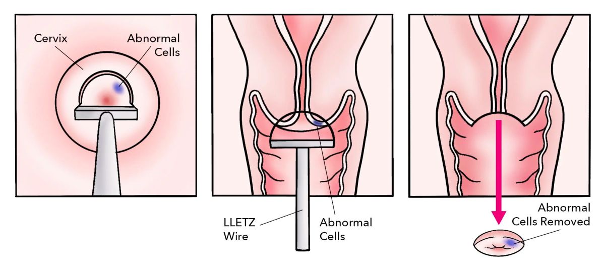 Surgical adhesions