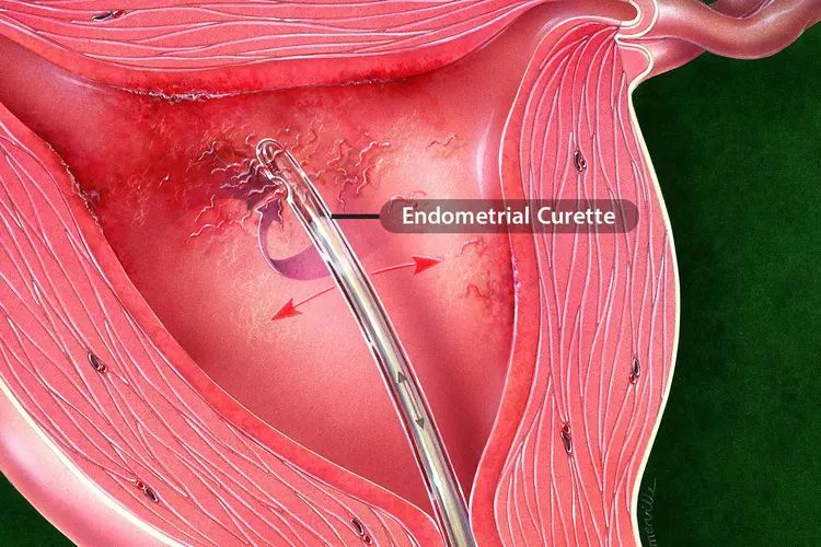 Pipelle endometrial biopsy curette